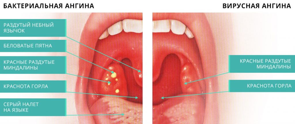 вирусная и бактериальная ангина вид горла