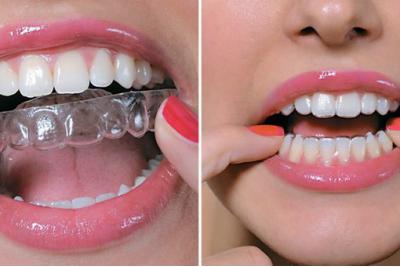 Как правильно провести диагностику для элайнеров, и получить здоровые и красивые зубы?